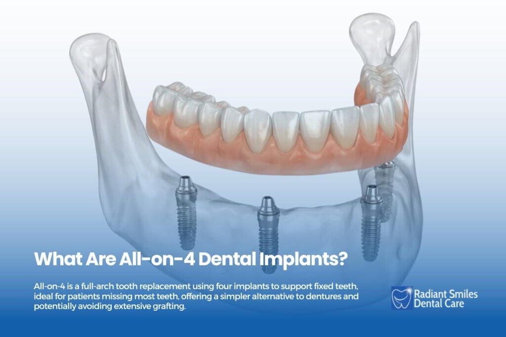 what are all on 4 dental implants how long does it take to get all on 4 dental implants